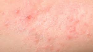 Adults usually develop heat rash on various parts of their body which rubs together like the inner thighs or the underarms. Prickly Heat Treatments Causes And More