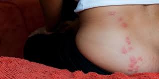 Each of the following pictures of bed bug bites shows typical skin reactions to the insect's saliva. How To Identify And Treat Bed Bug Bites Insider