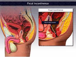 Image result for Fecal Incontinence