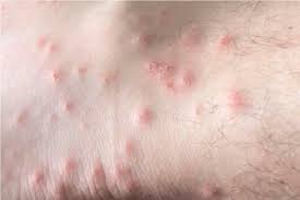 Fire Ant Allergy Treatment in New Orleans | Uptown Allergy & Asthma