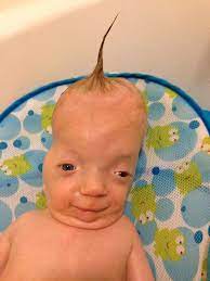 Boy Born With Unique Genetic Disorder Called Miracle Six Years Later