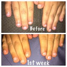 Apr 08, 2020 · nails grow back, but it may take time. 15 Products To Help Stop Nail Biting
