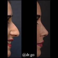 10 Rhinoplasty Before After Ideas Rhinoplasty Before And After Rhinoplasty Nose Job