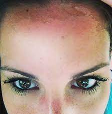 May 21, 2018 · the color and sting of a sunburn go away in three to 10 days, sometimes to be replaced by peeling. How To Remove Peeling Facial Skin Lip Service By Mel Dry Skin Treatment Dry Skin Diy Peeling Skin