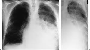 Pleural effusion is defined as the abnormal accumulation of fluid within the pleural space. Disease Of The Pleura Radiology Key