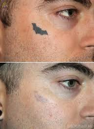 The method is known as dermabrasion. Efficient Removal Of Unwanted Tattoos Using Advanced Lasers