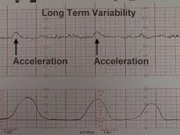 How Do You Read A Contractions Chart Babycenter