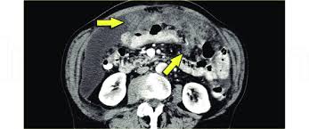 Omental Cake Arrows And Ascites In A Patient With Peritoneal Download Scientific Diagram