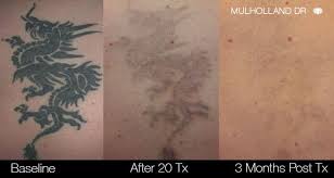 With our undo your tattoo guarantee, there's no more worrying about how much it may cost. Laser Tattoo Removal Clinic Toronto See Our Before Afters