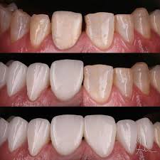 Case From Drmuntheralherani Power Of Laminate Veneers Yesterday Case Veneers Smileartist Smilestylist Smile Hollywoodsmile Ucla Cali Dentista
