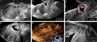 Image result for First Trimester Ultrasound
