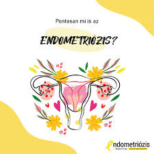 Endometriózis alatt azt értjük, amikor a méh nyálkahártyasejtjei nem a méhben, hanem a testben máshol, a méh üregén kívül endometriózis állhat a meddőség hátterében? Endometriozis Magyarorszag Posts Facebook