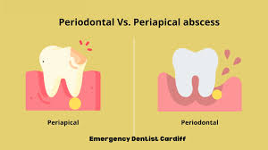 Image result for Periapical Abscess