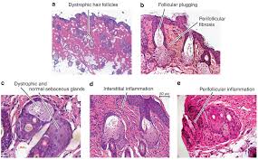 Hair Follicle Stem Cell Specific Ppargamma Deletion Causes Scarring Alopecia Abstract Europe Pmc