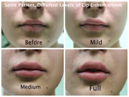What do you need to know before getting lip injections? Lip Filler Lip Injection Botox Lip Flip Sherman Oaks Ca