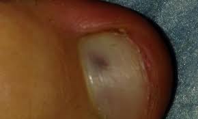 Dunkler Fleck Unter Grossem Zehennagel Was Ist Das Grosser Zeh Schwarzer Fleck