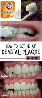 Plaque is a sticky, soft film of bacteria that builds up on your teeth, dental fillings, gums, tongue, dentures and crowns. Maintaining Good Oral Health Is Important For Overall Health And Confidence And Plaque Is A Common Problem You May Dental Plaque Health Natural Home Remedies