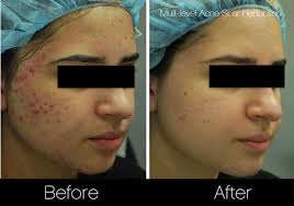 Jul 24, 2018 · on average, a single laser treatment to improve the appearance of a scar costs between $200 and $3,400, according to the university of michigan's department of dermatology. Acne Scar Treatment In Toronto Spamedica