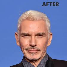 Billy Bob Thornton Hair Transplant Simulation