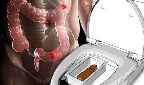 Bowel Cancer Test: How To Check Your Risk Of Bowel Cancer At Home For Free  | Express.co.uk
