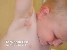 Image result for scabies human children