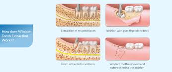 Maybe you would like to learn more about one of these? Wisdom Tooth Extraction