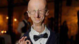 Murió a los 28 años, Sammy Basso, científico italiano que estudió el  síndrome del envejecimiento, enfermedad