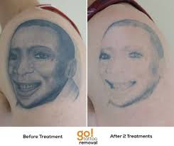 Tattoos used to be considered permanent, but thanks to advances in laser technology, today's lasers can get rid of has a tattoo lost its appeal? Soft Grey Wash Almost Always Fades Significantly Faster Than Darker More Heavily Saturated Areas A Few More And T Tattoo Removal Tattoos Laser Tattoo Removal