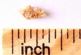 kidney stones pain symptoms causes passing a kidney