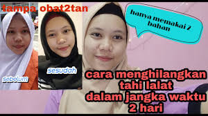 Lantas banyak yang ingin tahu cara menghilangkan tahi lalat untuk mengatasi. Tutorial Cara Menghilangkan Tahi Lalat Dalam Jangka Waktu 2 Hari Youtube