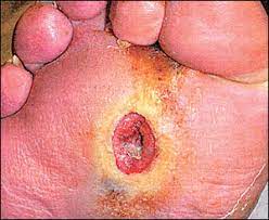 We did not find results for: Diabetic Foot Ulcers Pathogenesis And Management American Family Physician