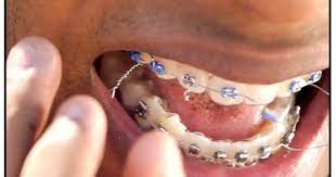 How To Deal With Broken Braces Orthodontics Braces Dental Braces Teeth Braces