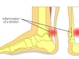 Sakit tumit kaki adalah antara sakit yang dialami oleh warga emas pada zaman dahulu kala. Ini 7 Penyebab Nyeri Tumit Yang Paling Sering Terjadi