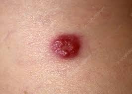 Image result for Merkel Cell Carcinoma