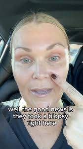 Some of you may know I recently had MOHS surgery, so when this spot popped  up