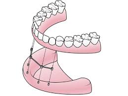Maybe you would like to learn more about one of these? Implant Supported Dentures Implant Dentures Oklahoma City Ok