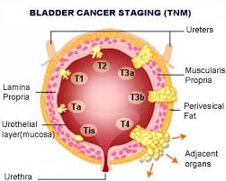 Some symptoms of bladder cancer are also symptoms of other conditions, and should prompt a visit to your physician. Pin On Cancer Research