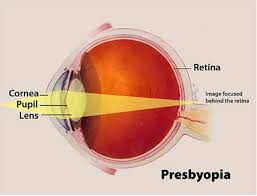 Difference Between Myopia Hypermetropia And Presbyopia