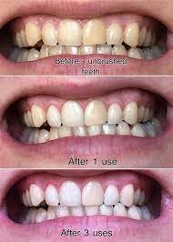 19 Teeth Whiteners That Work So Well It S Basically Magic