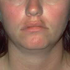 What S That On Your Face Acne Rosacea Symptoms Rosacea Skin Care Rosacea Symptoms