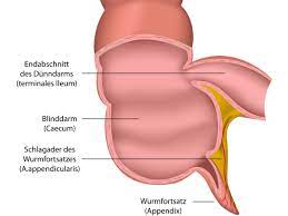 Appendicitis, almonds out, broken arm.: Blinddarmentzundung Im Zweifel Lieber Eine Operation Heilpraxis