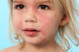 Baby allergies to lotions, laundry detergent and other allergens that touch the skin may manifest in a rash or hives. 5 Rashes Your Child May Bring Home From Preschool Cleveland Clinic