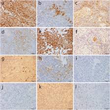 Glioblastoma is the most common type of malignant brain tumor in adults. Localized Biphasic Malignant Mesothelioma Presenting As A Giant Pelvic Wall Mass A Rare Case Report And Literature Review Bmc Medical Imaging Full Text