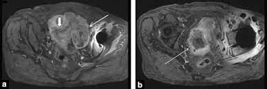 By the time ovarian cancer is considered as a possible cause of these symptoms. Digestive Diseases Mimicking Primary Gynecological Diseases Or With Secondary Gynecological Manifestations Sciencedirect