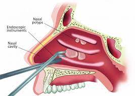 Nasal cyst or nasal cyst is a pathological formation in the nasal cavity. Nasal Polyps Euforea