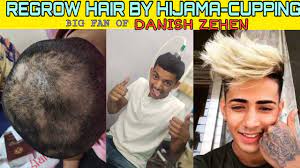 It is a general tonic for the brain and the body, and can improve the quality of hair growth on the head. Regrow Hair By Cupping Hijama For Hair Loss Fan Of Danish Zehen Alopecia Areata Asmr Youtube
