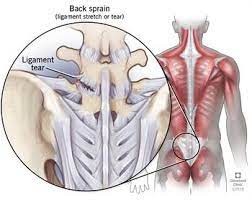 Anatomical diagrams of the spine and back. Back Strains And Sprains