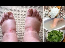 See The Top Swollen Feet Home Remedies Including Plants Oils Exercises And More That Really Work Chec Foot Remedies Water Retention Water Retention Remedies