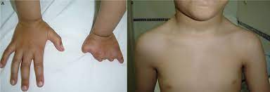 Le syndrome de poland est une maladie congénitale rare qui se traduit par diverses anomalies de développement affectant le thorax et le membre supérieur sur un seul côté du corps, trois fois sur quatre du côté droit. Figure Figure 1 Syndrome De Poland B