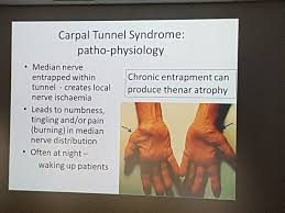 This is the nerve in the wrist that allows feeling and movement to parts of the hand. Yusuf Michla On Twitter The Median Nerve At The Wrist Is Compressed In Carpal Tunnel Syndrome There Is Wasting Of The Abductor Pollicis Brevis Muscle Numbness In The Orange Area If